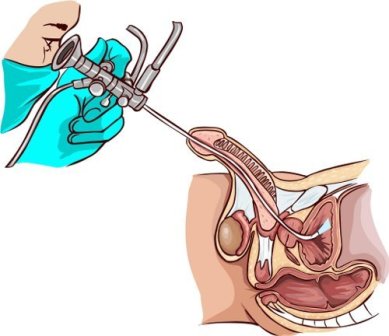 Лечение полипа уретры, мочевого пузыря, фото
